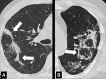 Perilobular: Transverse CT images of the (A) right and (B) left lung in
two different patients show opacities with perilobular distribution (arrows). 