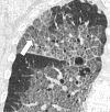 Septal thickening: Coronal CT image of the right lung shows septal
thickening and intralobular lines (arrow) in an area of crazy paving. 