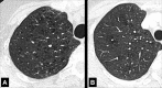 Centrilobular: (A, B) Transverse CT images of the right upper lobes of two
different patients show centrilobular emphysema. 