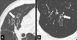 Bronchiectasis: Transverse CT images of the lungs in two different
patients show severe bronchiectasis (solid arrow) in (A) right upper lobe and
milder bronchiectasis (solid arrow) in (B) left lower lobe. Note the smaller
diameter of the accompanying pulmonary artery (signet ring sign) (open arrow). 