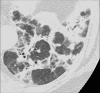 Perilobular: Transverse CT image of the left lower lobe shows opacities
with perilobular distribution. 