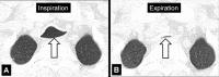 Tracheomalacia: Transverse CT images of the upper thorax. (A) In
inspiration, the shape of the trachea (arrow) is abnormal, with an increased
transverse diameter. (B) Expiration shows near-complete tracheal collapse
(arrow). 