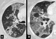 Geographic: (A, B) Transverse contrast-enhanced CT images of the right
lung in two different patients show ground-glass opacities with geographic
distribution. 