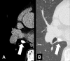 Lymph node: Transverse CT images in (A) soft tissue and (B) lung window
show calcified mediastinal lymph node (arrow). 