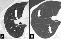 Fissural: Transverse CT images of the right lung in two different patients
show (A) solitary and (B) multiple perifissural micronodules (arrows). 