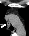 Lymph node: Transverse CT image of the mediastinum shows mediastinal lymph
node (arrow) with fatty hilum. 