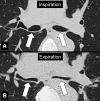 Bronchomalacia: Transverse CT image at the level of the main bronchi in
(A) inspiration and (B) expiration. Expiration causes substantial collapse of
the main bronchi (arrows). 