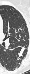 Perilymphatic micronodules: Transverse CT image of the left lung shows
micronodules with perilymphatic distribution along the fissure (open arrow) and
the bronchus (solid arrow). 