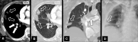 Embolism with infarction: Transverse contrast-enhanced CT images in (A)
soft tissue and (B) lung window show emboli (solid arrows) and corresponding
infarction (open arrows). (C) Coronal CT image reconstruction and (D) frontal
chest radiograph in the same patient show central embolus (solid arrow) and
peripheral infarction (open arrow). Emphysema. 