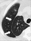Azygos: Transverse CT image of the right upper lobe shows azygos fissure
(arrows). This structure is in fact a pseudofissure, as it consists of four
rather than the normal two pleural layers. 