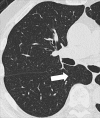 Azygo-esophageal recess: Transverse CT image of the right lung shows the
azygo-esophageal recess (arrow), bordered by the azygos vein and the neighboring
esophagus. 