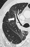 Peribronchovascular: Transverse contrast-enhanced CT image of the right
lung shows radiation reaction with peribronchovascular thickening (arrow). 