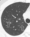 Micronodule: Transverse CT image of the right upper lobe shows multiple
micronodules (arrows). 
