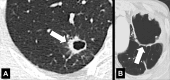 Cavity: Transverse CT image of the (A) right and (B) left upper lobe in
two different patients show gas-filled structures with thick and partially
irregular walls (arrow). 