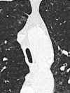 Saber-sheath trachea: Transverse CT image of the mid trachea shows
saber-sheath configuration. 