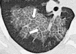 Septal thickening: Transverse CT image of the right lower lobe shows
septal thickening and intralobular lines (arrows) in an area of crazy paving. 