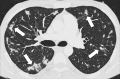 Multifocal: Transverse CT image shows multifocal opacities (arrows). 