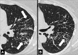 Perilymphatic micronodules: (A, B) Transverse CT images of the left lung
in the same patient at different levels show micronodules with perilymphatic
distribution (arrows). 