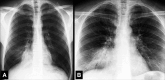 Silhouette sign: (A, B) Frontal chest radiographs of two different
patients show obscuration of right-sided heart border by adjacent consolidation
in the middle lobe. 