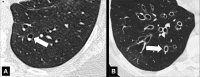 Signet ring sign: Transverse CT images of the (A) left and (B) right lower
lobe in two different patients show dilated bronchi accompanied by smaller
pulmonary arteries (arrow). 