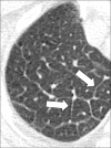 Septum: Transverse CT image of the right upper lobe shows thickened
interlobular septa (arrows). 