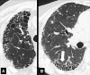 Honeycombing: (A, B) Transverse CT image of the right lung in two
different patients shows honeycombing (arrow). 