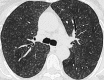 Centrilobular: Transverse CT image of the lungs shows diffuse
centrilobular micronodules. 