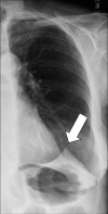 Juxtaphrenic peak: Frontal chest radiograph of the left lung shows
juxtaphrenic peak (arrow). 