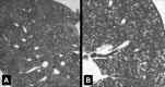 Centrilobular: Transverse CT images of (A) right and (B) left lungs in two
different patients show diffuse centrilobular micronodules. 
