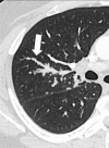 Peribronchovascular: Transverse CT image of the right lung shows nodules
with peribronchovascular distribution (arrow). 