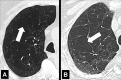 Panlobular: (A, B) Transverse CT images of the right upper lobes of two
different patients show panlobular emphysema (arrow). 