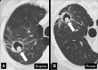 Mycetoma: Transverse CT images of the right upper lobe in (A) supine and
(B) prone position show mycetoma (arrow) within a preexisting cavity surrounded
by abnormal lung parenchyma, changing position with gravity. 