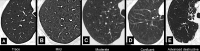 Visual subtypes of centrilobular emphysema: Transverse CT images of the
right lung in different patients show visual subtypes of centrilobular emphysema
according to reference 63: (A) trace emphysema, (B) mild emphysema, (C) moderate
emphysema, (D) confluent emphysema, and (E) advanced destructive emphysema. 
