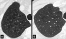 Centrilobular: (A, B) Transverse CT images of the right upper lobes of two
different patients show centrilobular emphysema. 