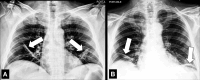Atelectasis: (A, B) Frontal chest radiographs of two different patients
show bilateral linear atelectasis (arrows). 