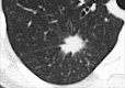 Nodule: Transverse CT image shows a markedly spiculated nodule in the
right lower lobe. 