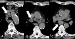 Lymphadenopathy: (A–C) Transverse CT images of the mediastinum show
mediastinal lymph node enlargement (arrows). 