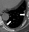 Extrapleural: Transverse CT image of the left lower lobe shows
extrapleural fat (arrows). 
