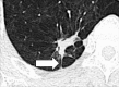 Irregular margination of pulmonary nodule: Transverse CT image of the
right lower lobe shows an irregular nodule with spiculations and pleural tags
(arrow). 
