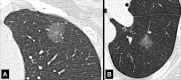 Nodule: Transverse CT image of the (A) left upper and (B) left lower lobes
of two different patients show ground-glass nodules with irregular margins. 