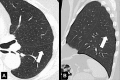 Accessory: (A) Transverse and (B) sagittal CT images of the left lung of
the same patient show accessory fissure in the left lower lobe (arrow). 