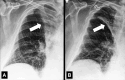 Atelectasis: Frontal chest radiographs of the right lung in the same
patient show (A) complete and (B) partial atelectasis (arrow) of the right upper
lobe. 