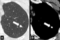 Nodule: Transverse CT images in (A) lung and (B) soft tissue window of the
left upper lobe show calcified nodule (arrow). 