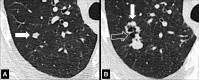 Nodule: Transverse CT images of the right upper lobe show the evolution of
a nodule from (A) soft tissue (arrow) to (B) a nodule with cystic (open arrow)
and soft tissue (solid arrow) components. 
