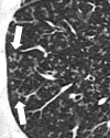 Tree-in-bud: Transverse CT image of right lung shows focal tree-in-bud
opacities (arrows). 