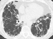 Asbestosis: Transverse CT images of the lower lobes show fibrosis
following asbestos exposure. Note that the presence of pleural plaques is not
required for the diagnosis. 