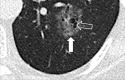 Nodule, complex morphology: Transverse CT image of the left lower lobe
shows a complex nodule with cystic (open arrow) and ground-glass (solid arrow)
components. 