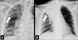 Atelectasis: Frontal chest radiographs of two different patients show (A)
partial and (B) complete right upper lobe atelectasis (arrows). 
