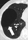 Bulla: Transverse CT image of the right upper lobe shows an air-containing
cystic structure lined by a thin layer of collapsed lung parenchyma (arrow). 