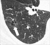 Nodule, complex morphology: Transverse CT image of the right lower lobe
shows a ground-glass nodule with a cystic component (arrow). 